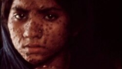 Как человечество победило оспу при помощи массовых прививок Как человечество победило оспу при помощи массовых прививок