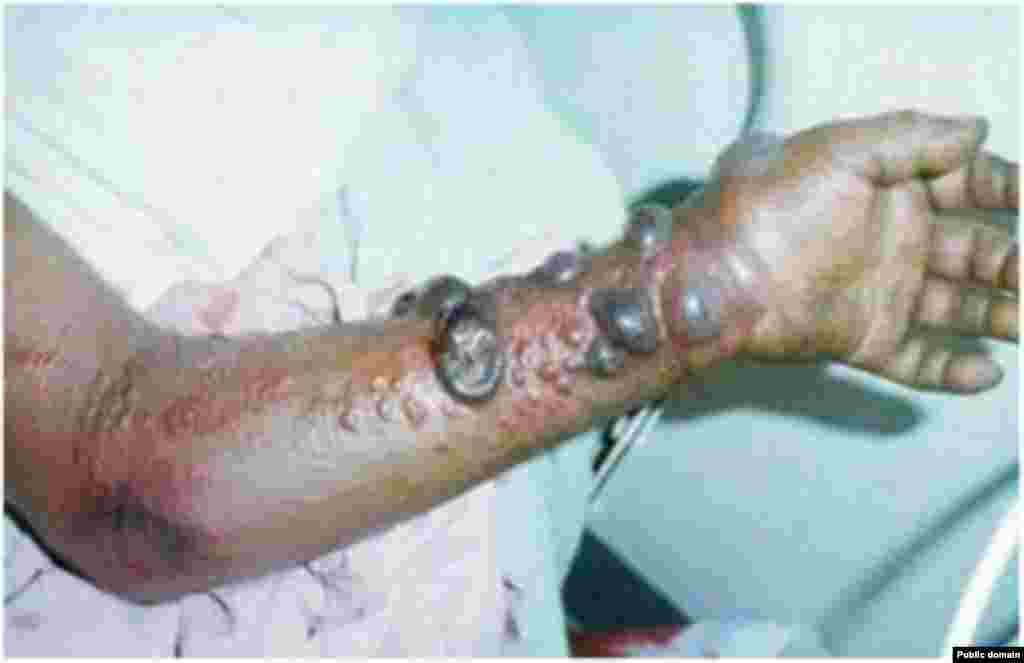 Больной лихорадкой Эбола. Руспублика Сьерра-Леоне. Июнь 2014  