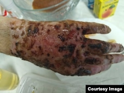 Вот такие руки были у Вячеслава после ранения